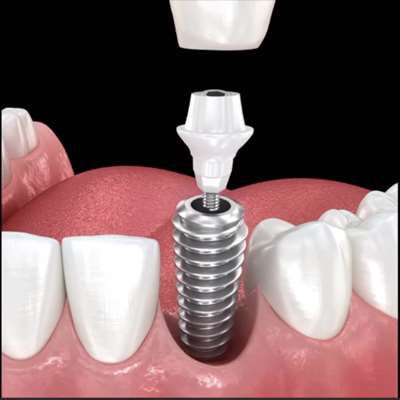 ایمپلنت تک واحدی