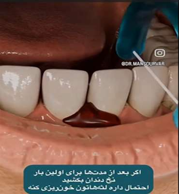 اگر برای اولین بار نخ دندان بکشید احتمال داره لثه هاتون خونریزی کنه